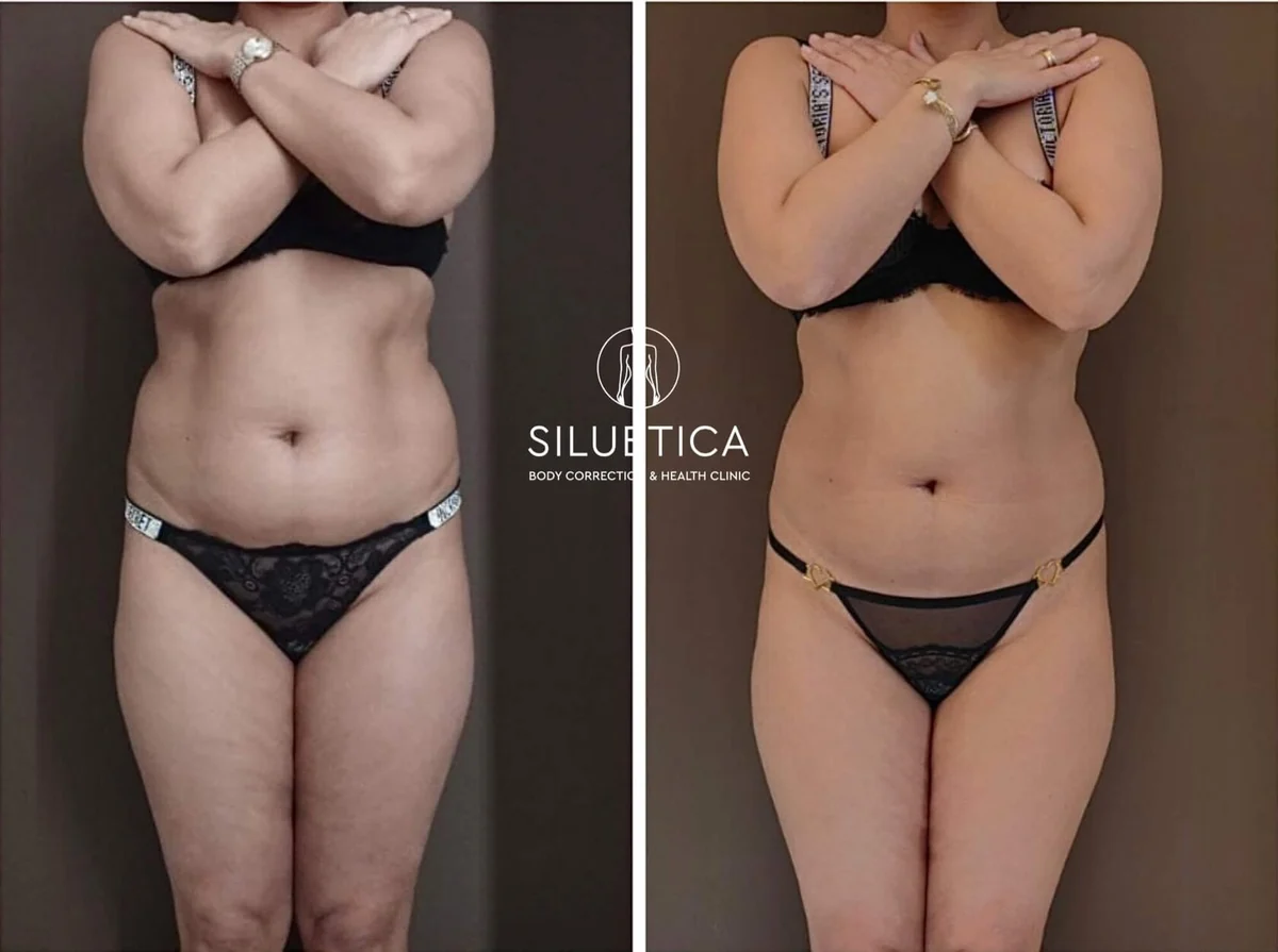 Результаты клиентов Siluetica