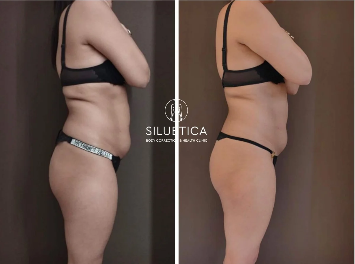 Результаты клиентов Siluetica