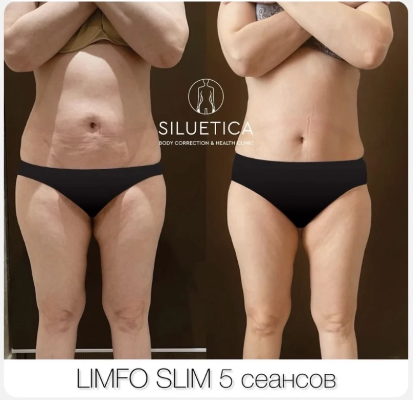 До и после: Limfo Slim — 5 сеансов
