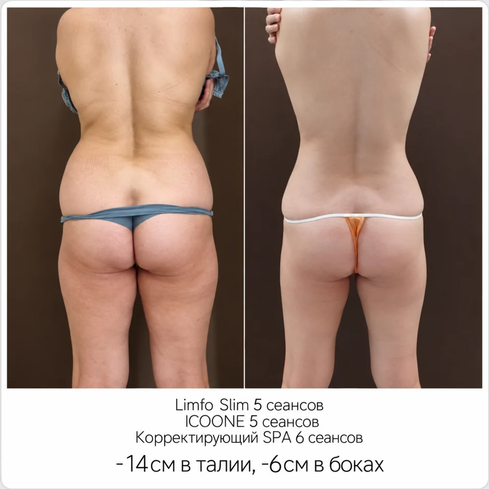 До и после: Limfo Slim, ICOONE и корректирующий спа