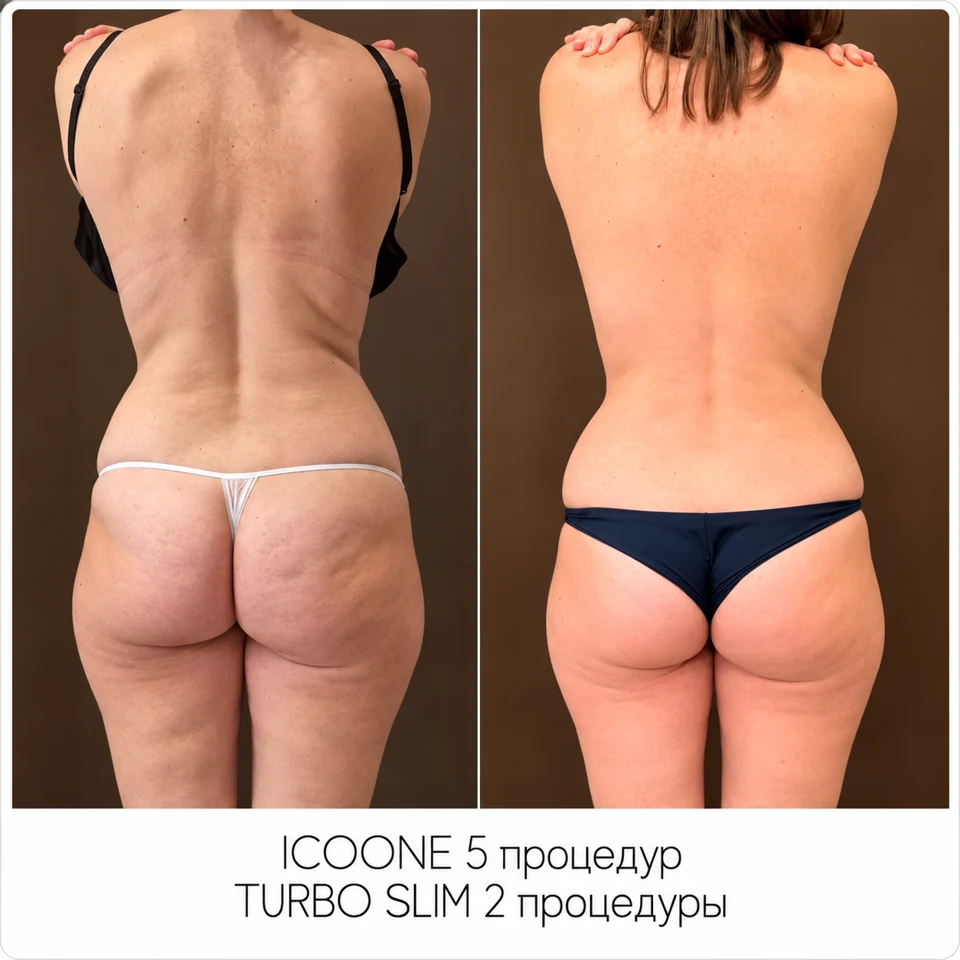 До и после: ICOONE — 5 процедур, Turbo Slim — 2 процедуры