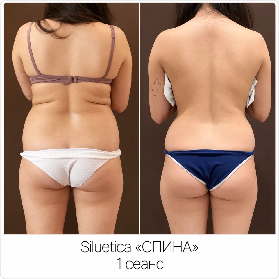До и после: SILUETICA — спина, 1 сеанс
