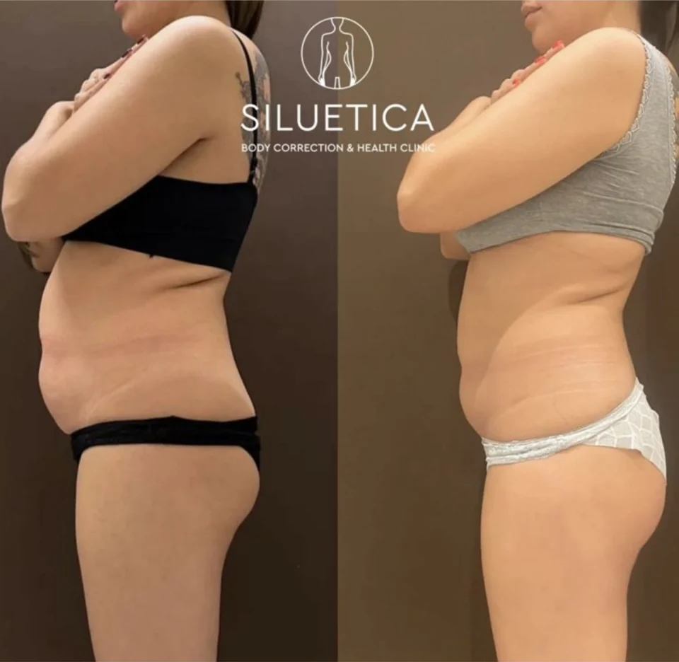 До и после: SILUETICA — результат коррекции тела
