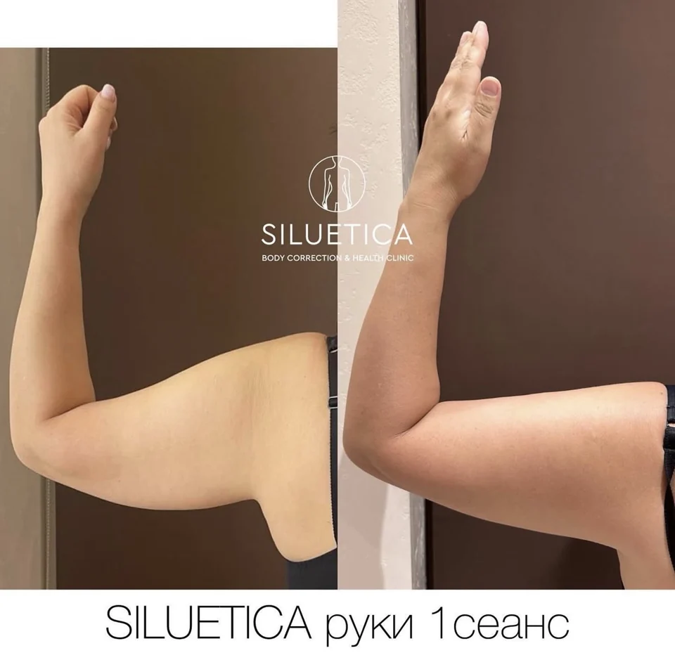 До и после: SILUETICA — руки, 1 сеанс