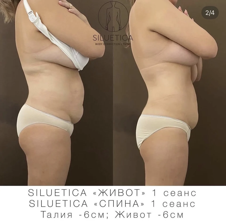 До и после: SILUETICA — живот и спина