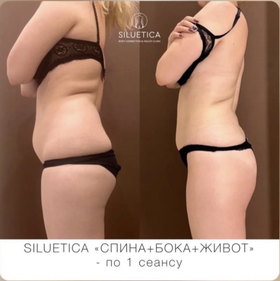 До и после: SILUETICA — спина, бока и живот