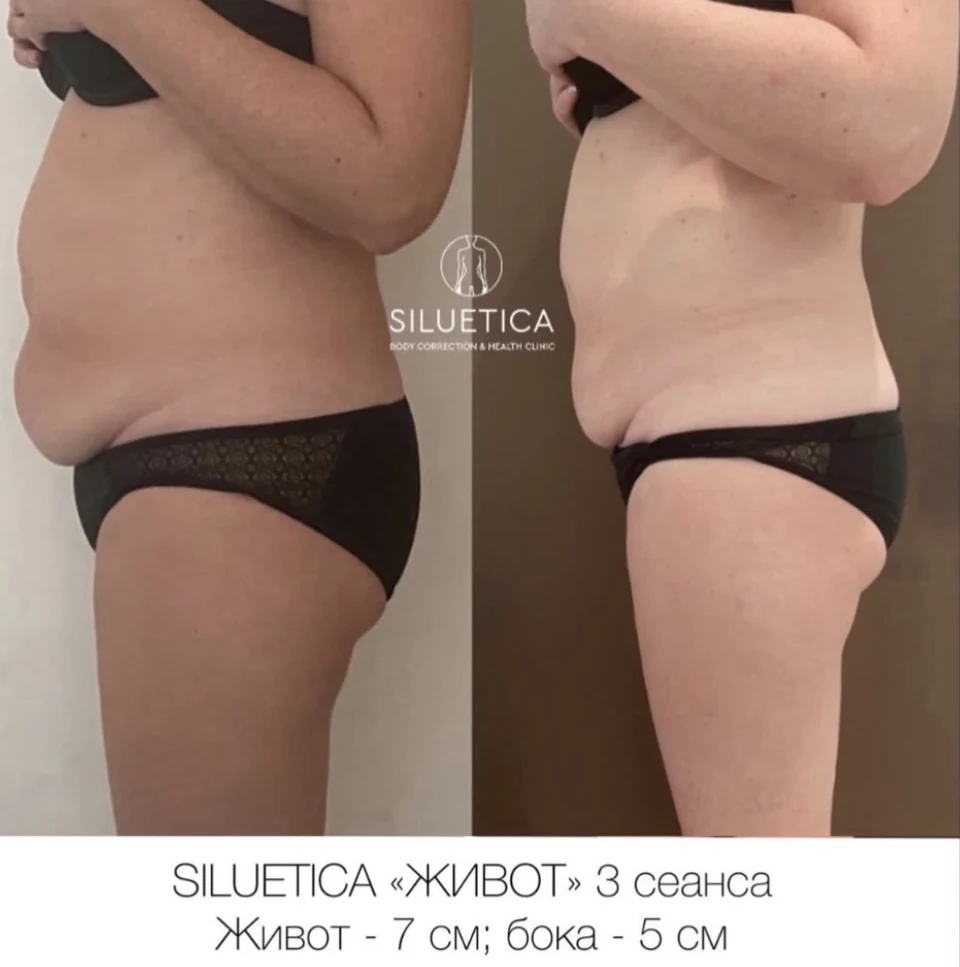 До и после: SILUETICA — живот, 3 сеанса