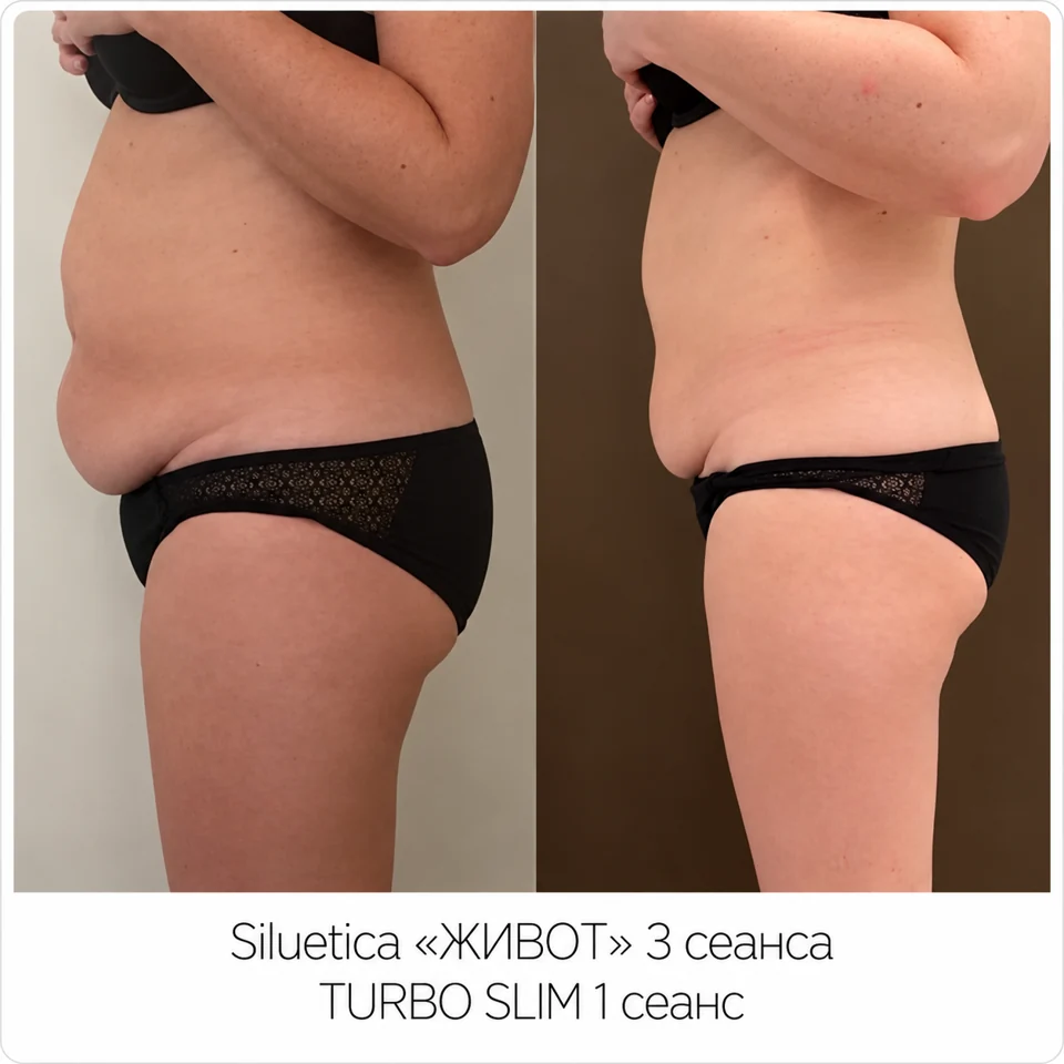 До и после: SILUETICA — живот и Turbo Slim