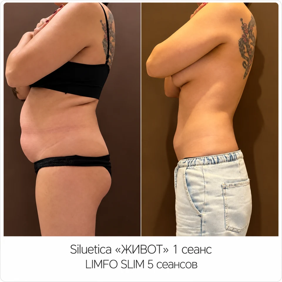 До и после: SILUETICA — живот и Limfo Slim